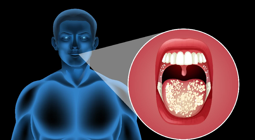 Sore throat