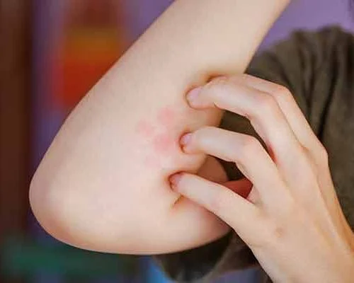 infected-insect-bite-service